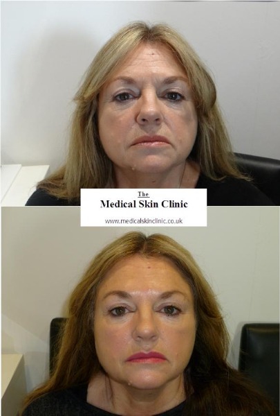 Dermal Fillers & Botox